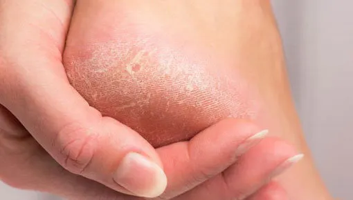 Foot callus